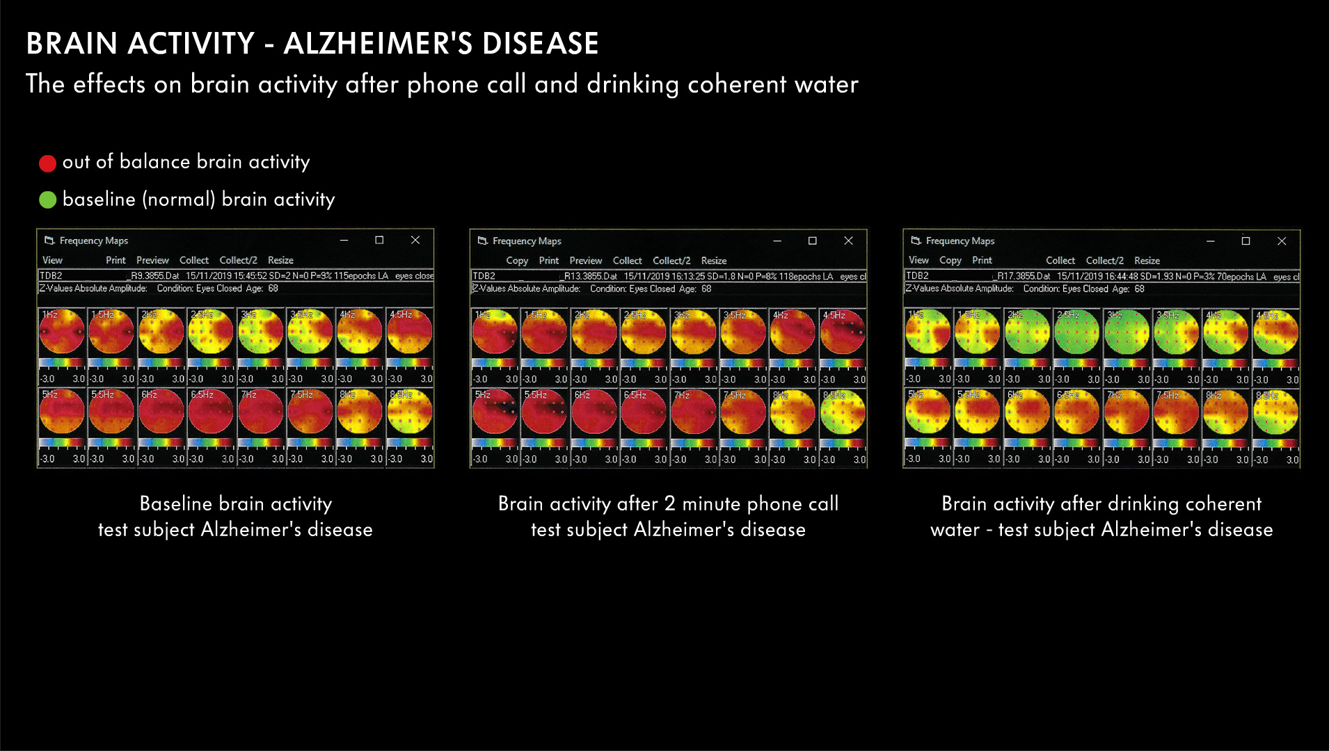 Brain-Activity-Alzheimer-01